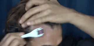 Derma Roller, 0.5mm For Hair And Skin Therap, Micro Needle Derma Roller With 540, Beauty Roller For Anti-Aging Skin Repair, Acne Scars Removal And Pores With 540 Titanium Needle For Men And Women